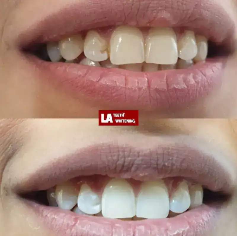 Teeth Whitening Laser Method Horsham Horsham