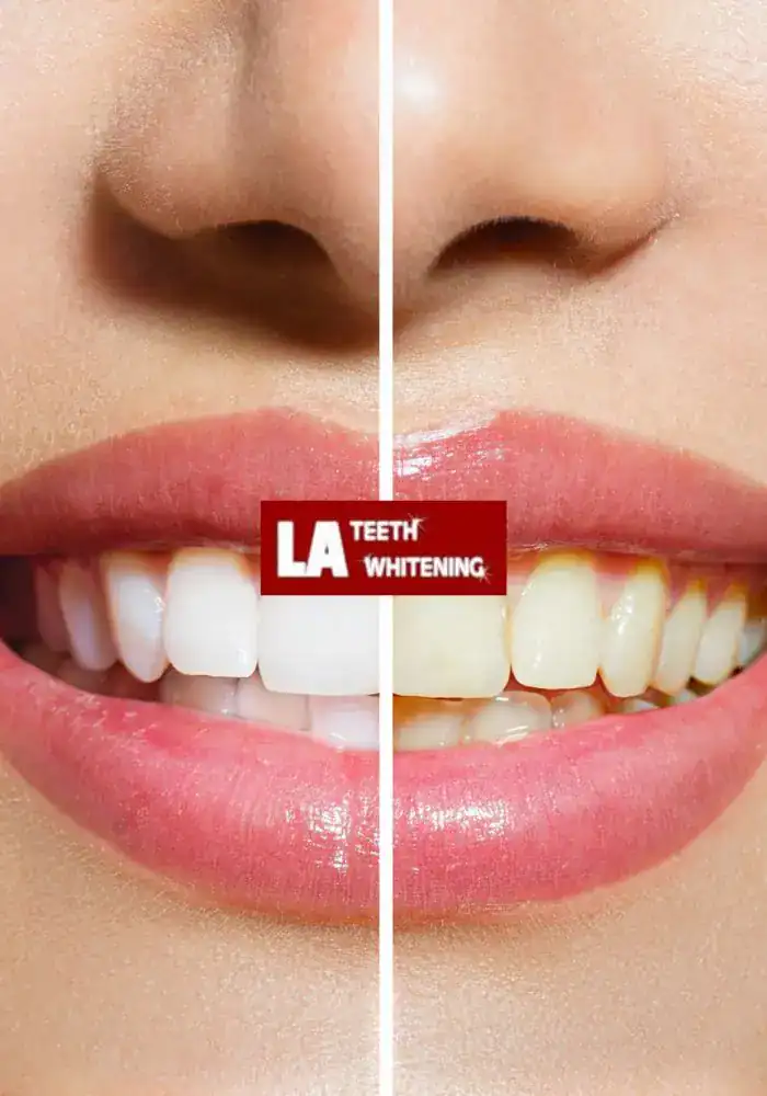 Why Don’t Porcelain and Resin Whiten the Same Way as Enamel Horsham