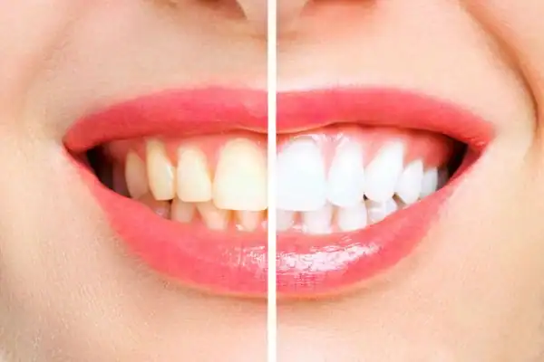 What Are the Common Myths About Laser Teeth Whitening Horsham